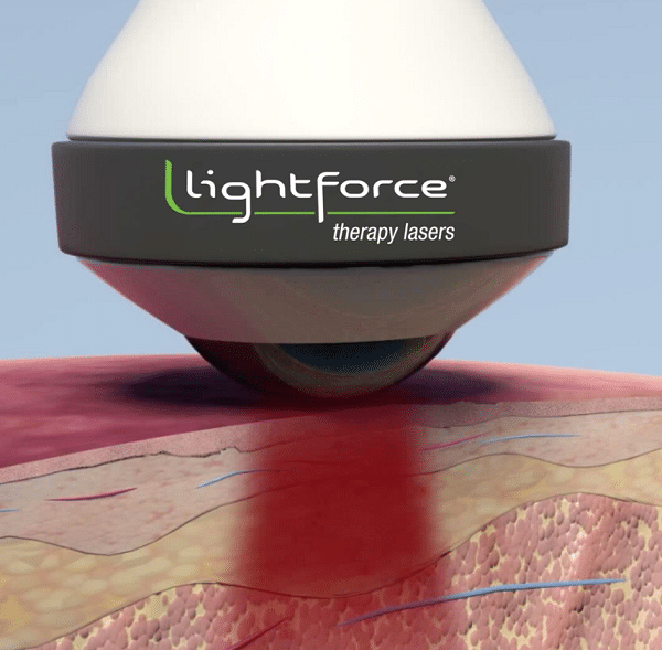 Lightforce Laser EXPI User-friendly operation that minimizes the learning curve for practitioners.
