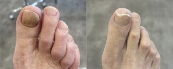 Lunula Laser Laser Fungus