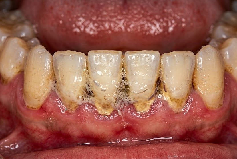 Severe dental calculus and plaque buildup on lower teeth before being treated effectively with Guided Biofilm Therapy.
