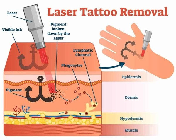 Laser Tattoo