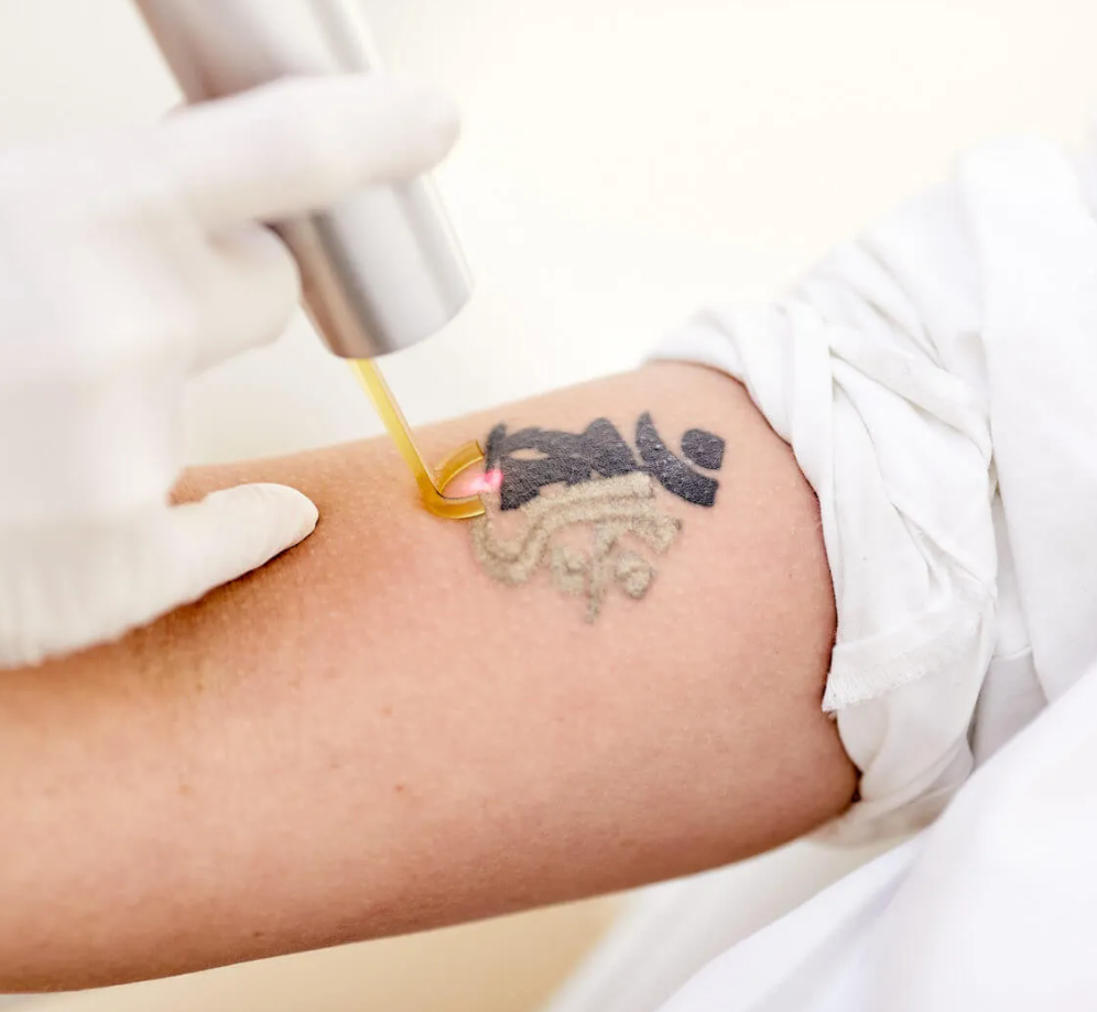 picosure tattoo removal