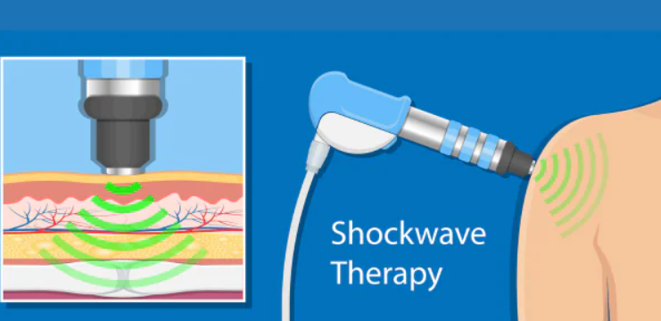 Shockwave Therapy