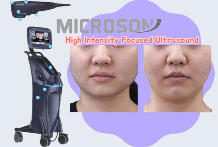 Microson HIFU: The Latest Innovation for Perfect Facial Contouring