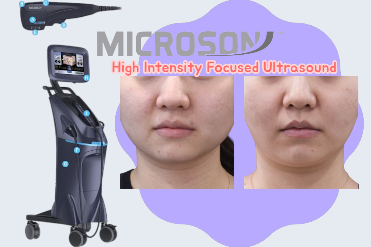 High Intensity Focused Ultrasound